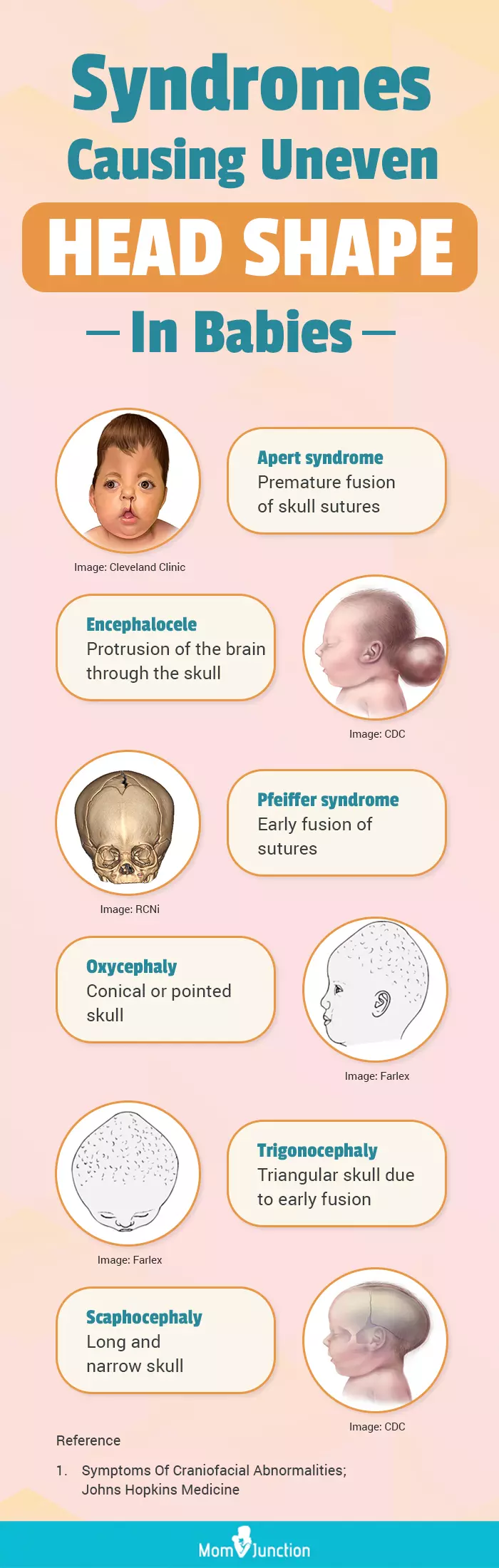 syndromes causing uneven head shape in babies (infographic)