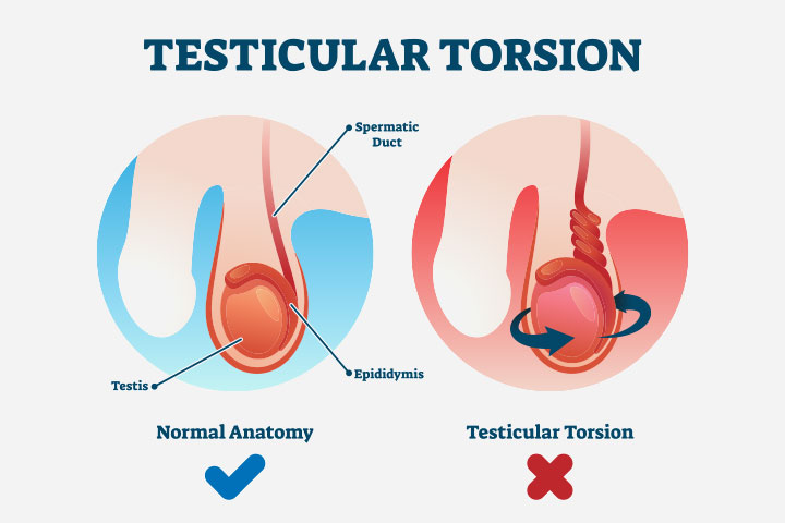 Testicular torsion may lead to testicular pain in teens