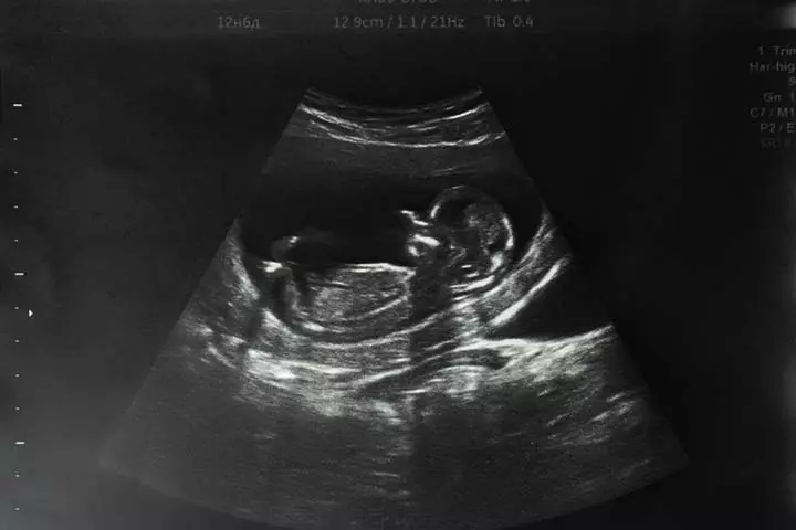 20 week scan of anterior placenta