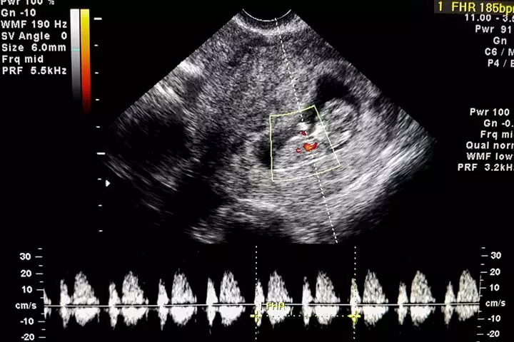 The CRL scan can help track heart rate