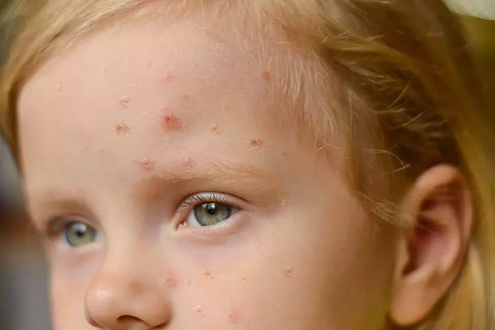Toddler acne often appears on the face