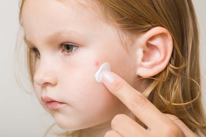 Topical application of medicines may help treat acne