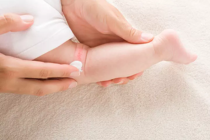 Topical ointments can provide relief and prevent baby's dry skin