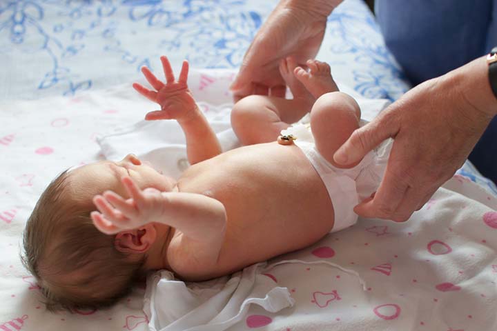 Umbilical hernia in babies