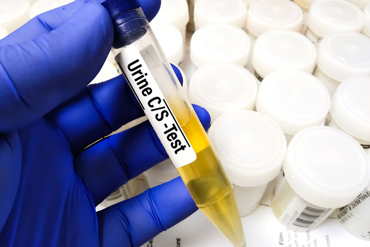 Urine culture helps the doctor identify the bacteria