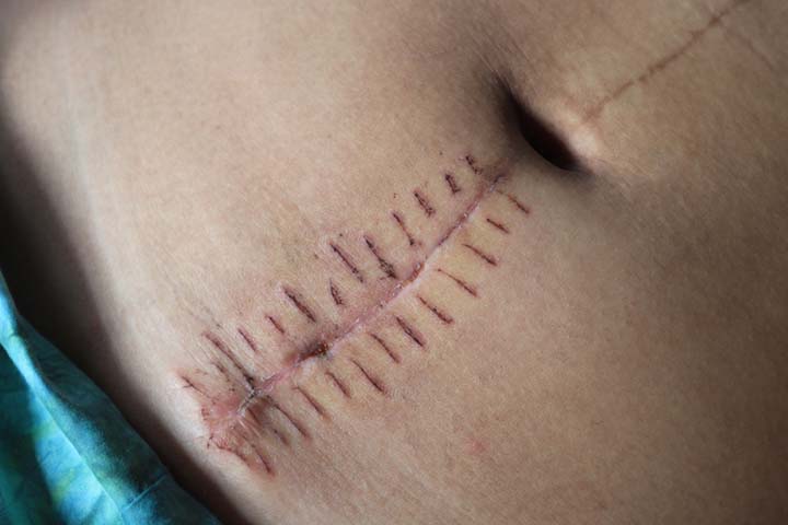 Wait for sufficient time for a C-section scar to heal.
