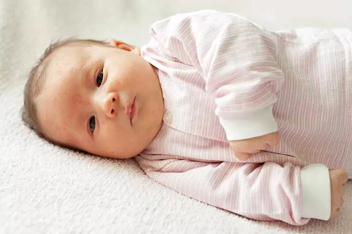 Why Do Pimples Occur In Children