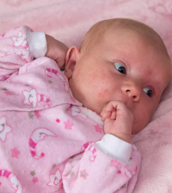 Why Does My Toddler Still Get 'Baby Acne'