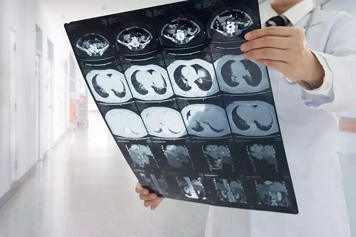 X-rays can point to the exact spot where the bowel slips out 