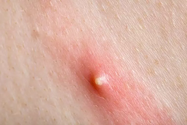 Yellow-white headed blisters, baby acne