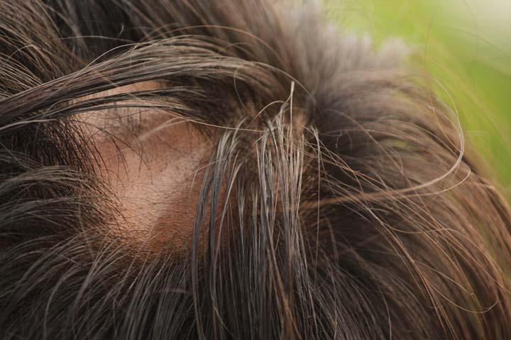 Alopecia areata is characterised by circular bald patches on any part of the body