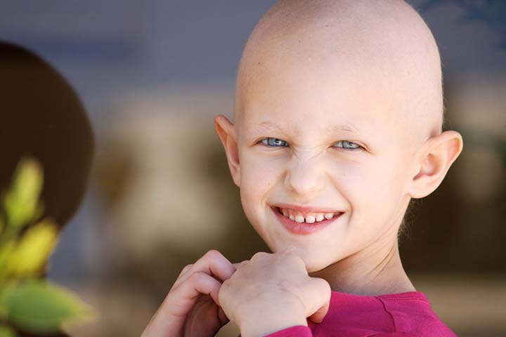 Clear skin with baldness is seen in children with alopecia areata