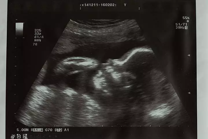 Fetal ultrasound scan