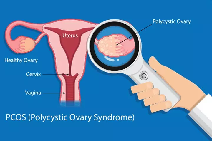 Metformin can be used for fertility treatment of woman with PCOS