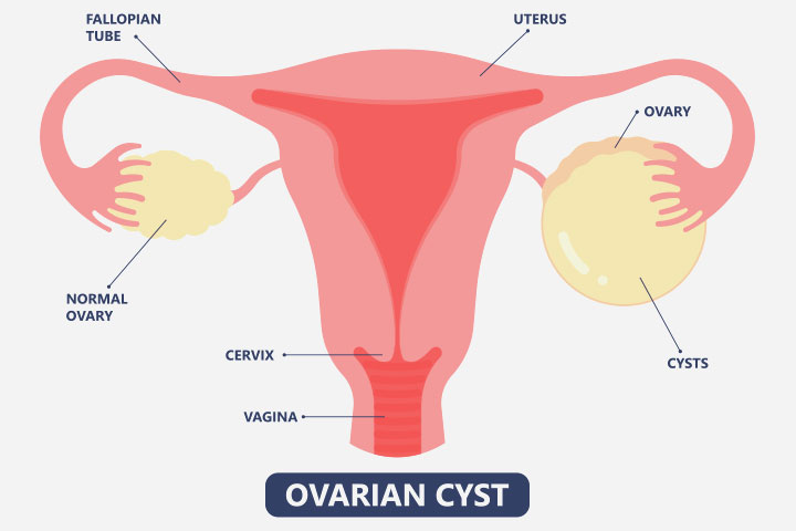 Ovarian cysts are a complication of molar pregnancy