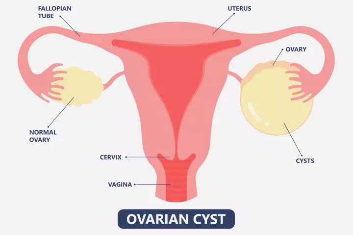 Ovarian cysts are a complication of molar pregnancy