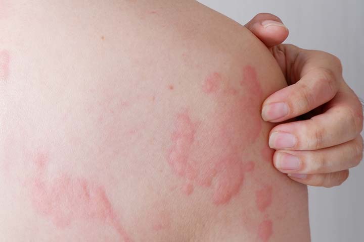 Tamiflu during pregnancy may cause hives