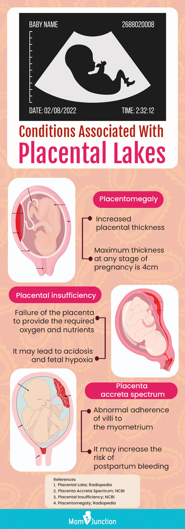 conditions associated with placental lakes [infographic]