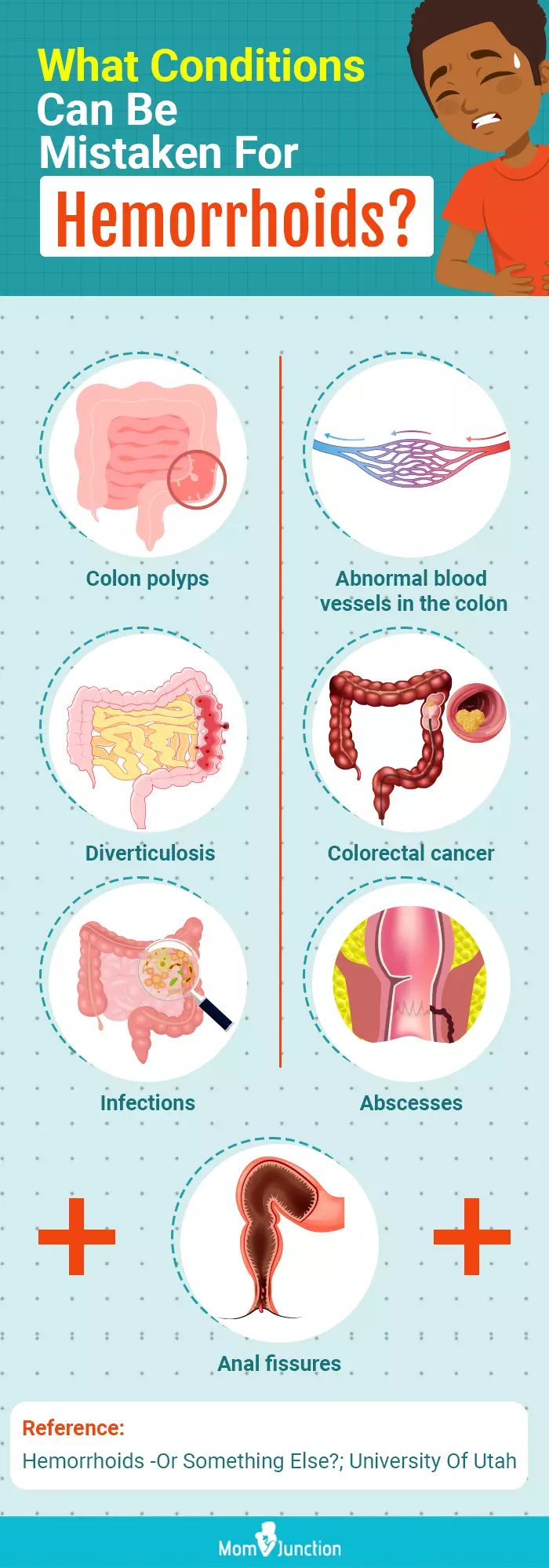 what conditions can be mistaken for hemorrhoids (infographic)