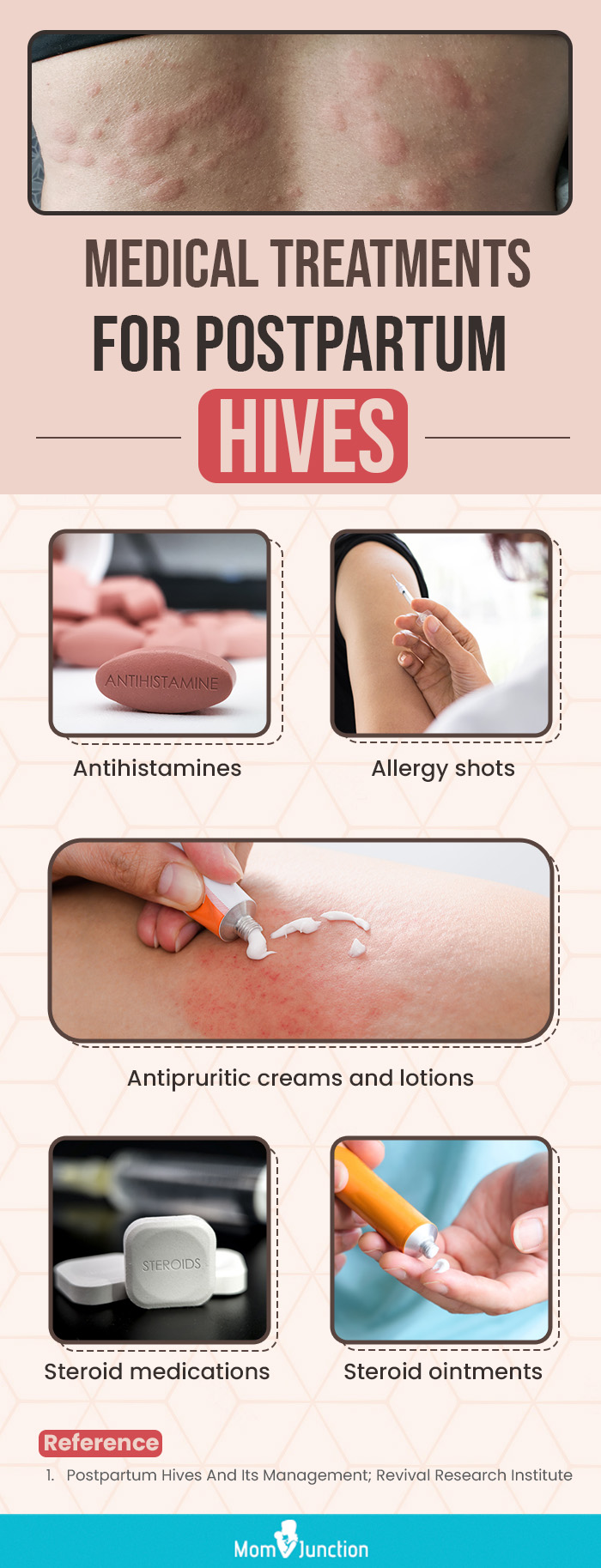 medical treatments for postpating hives (infographic)