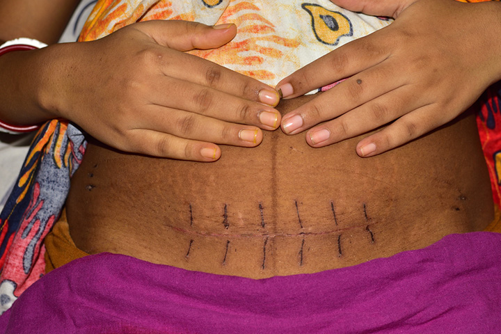 C-Section Swelling At The Incision