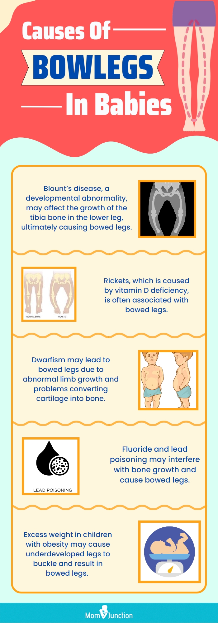 causes of bowlegs in babies (infographic)