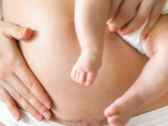 Is It Normal To Experience Swelling Above The Incision After Having A C- Section