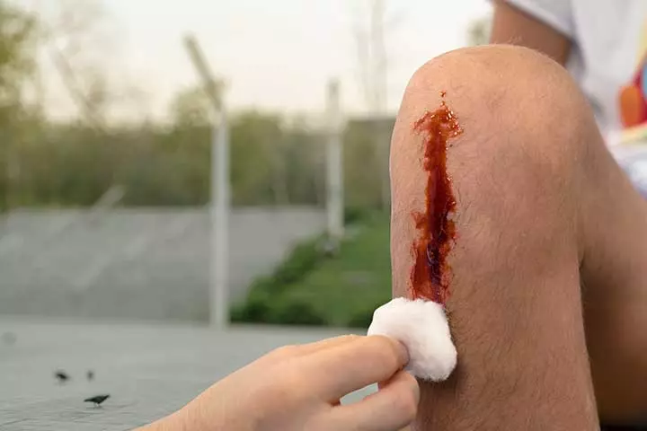 Hemophilia