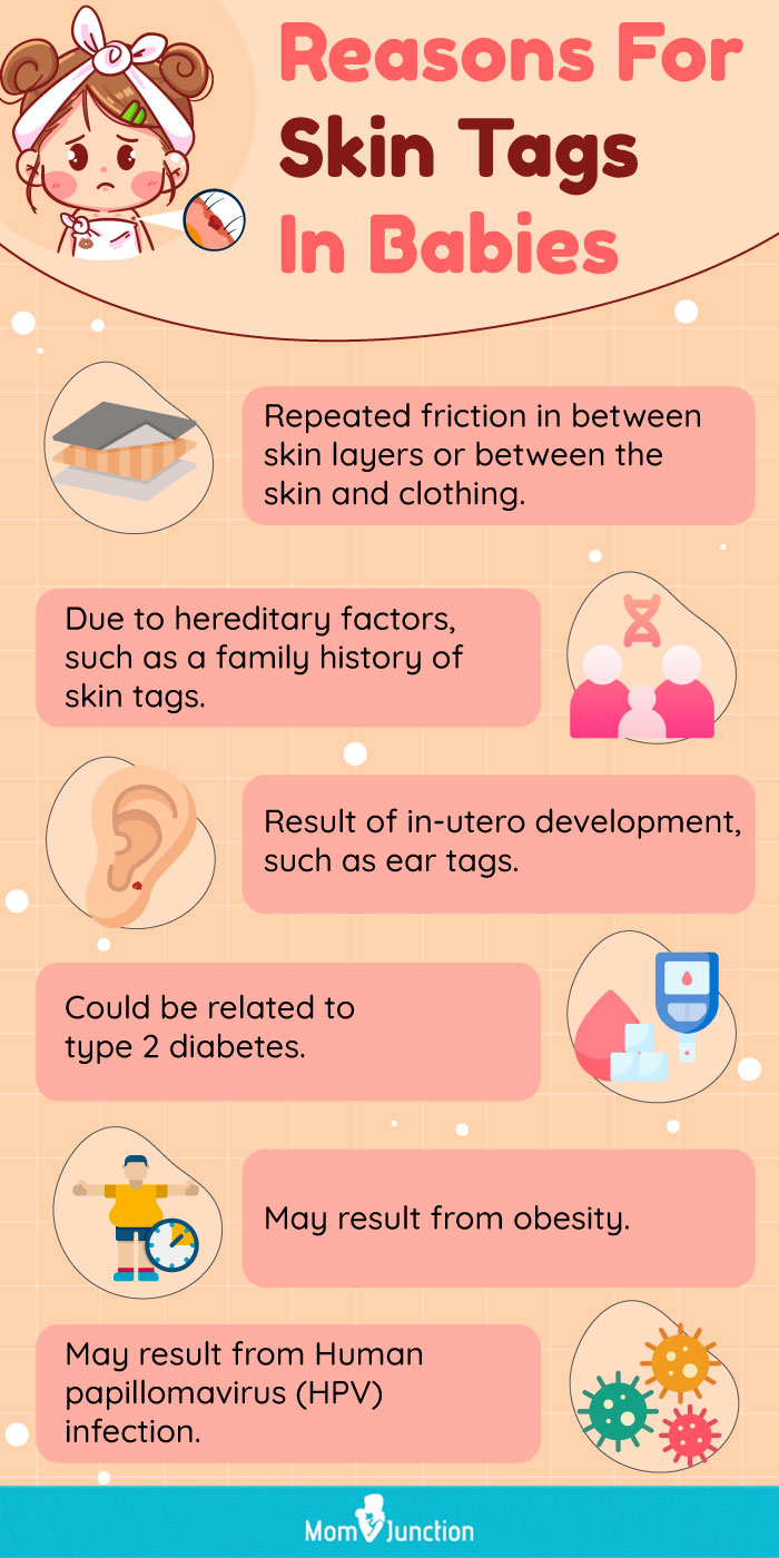reasons for skin tags in babies (infographic)