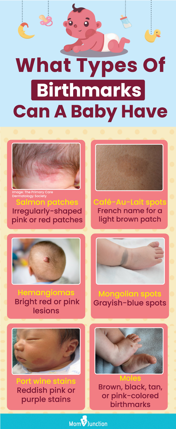 what types of birthmarks can a baby have (infographic)