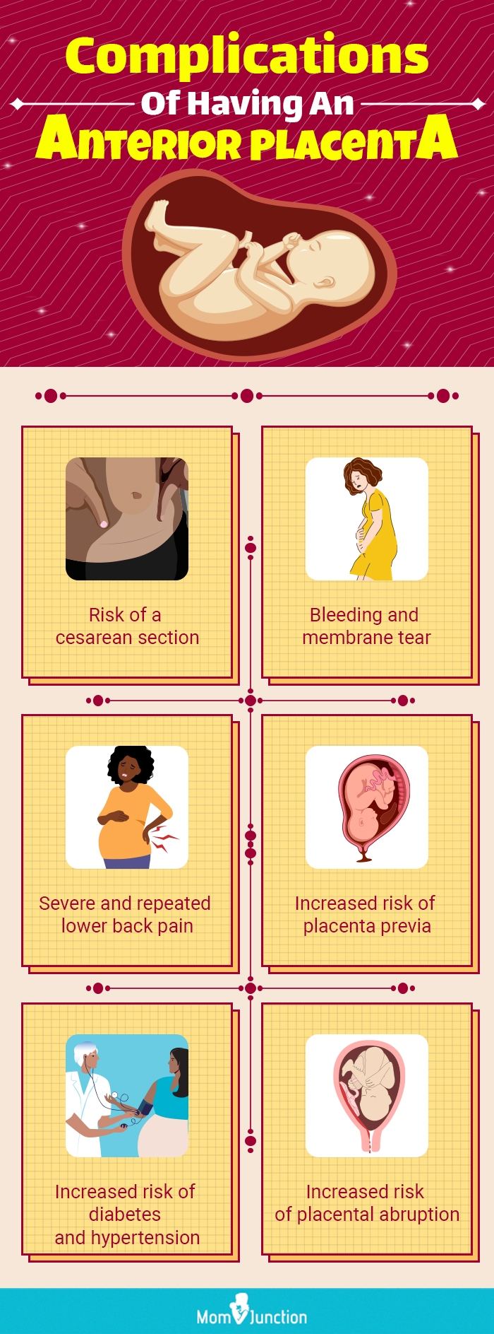 complications of having an anterior placenta (infographic)