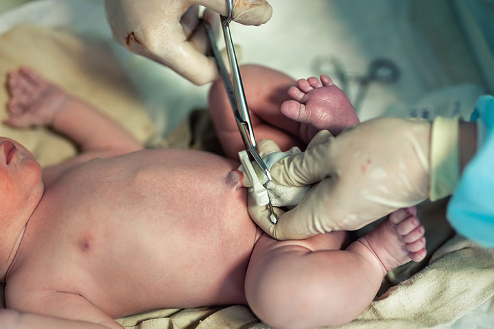 Umbilical cord clamping after it turns white