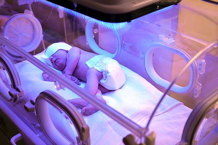  Newborn receiving phototherapy for jaundice