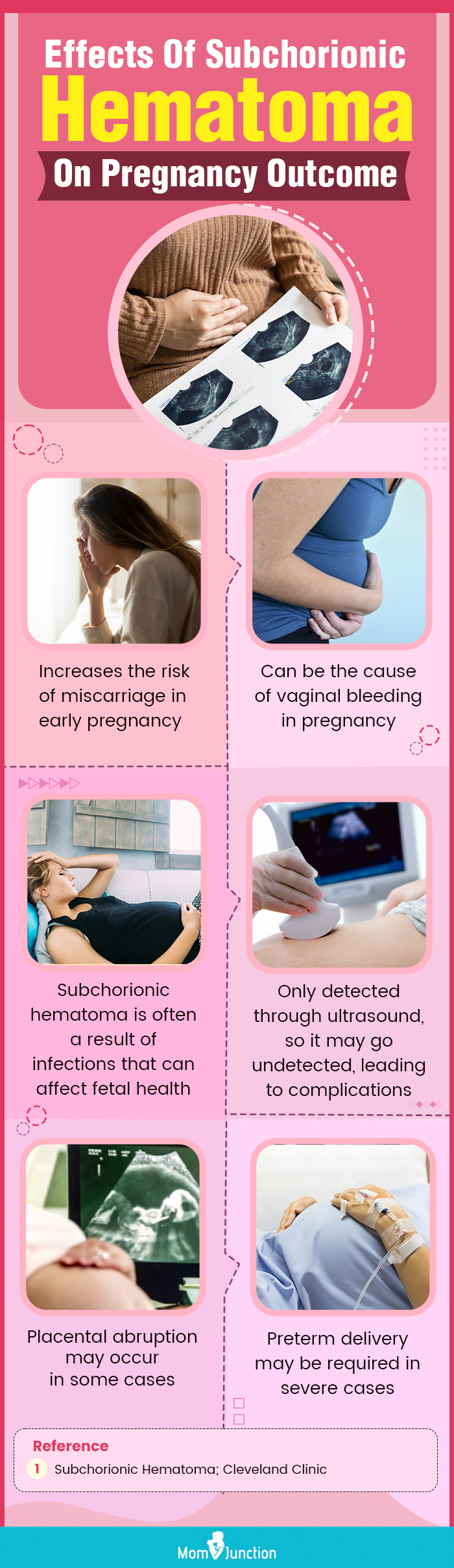effects of subchorionic hematoma on pregnancy outcome (infographic)