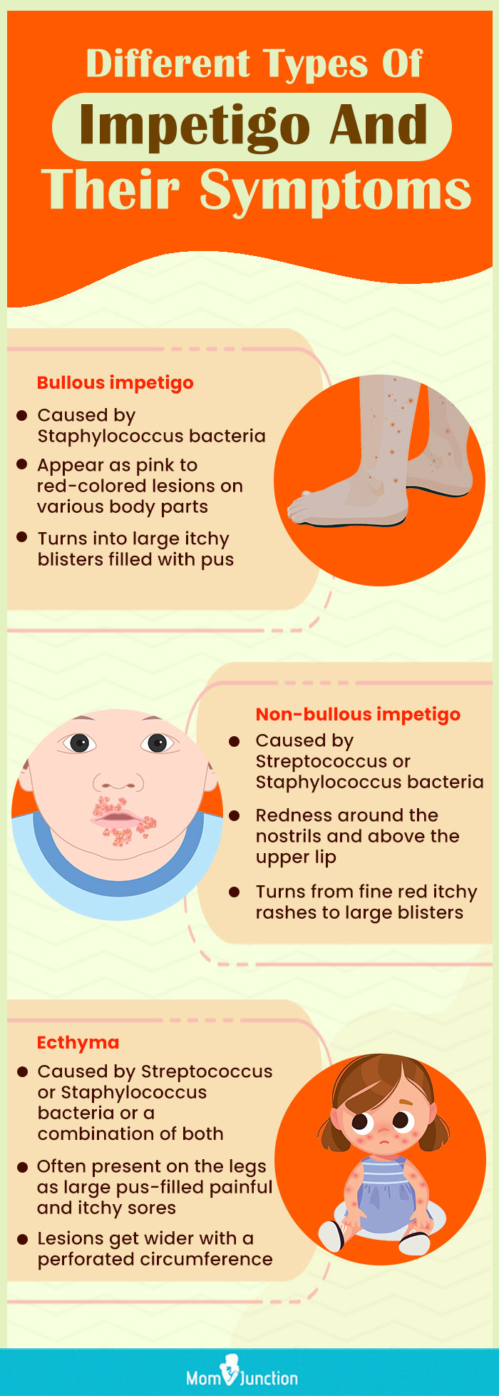 different types of impetigo and their symptoms (infographic)
