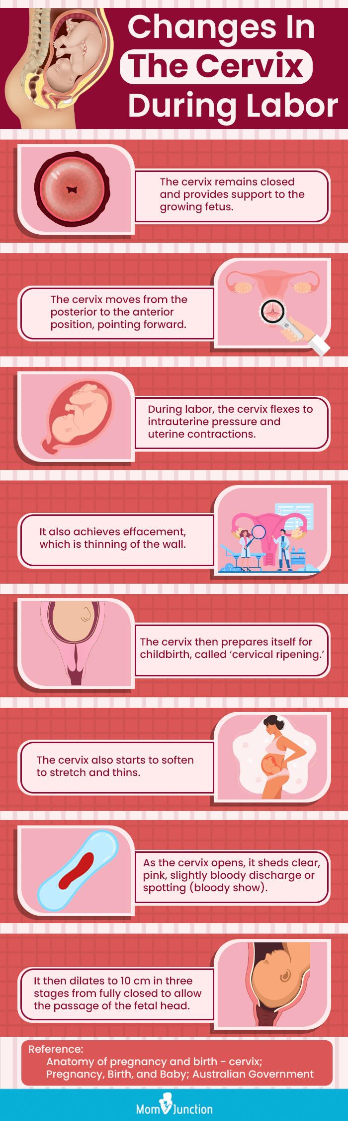 changes in the cervix during labor (infographic)