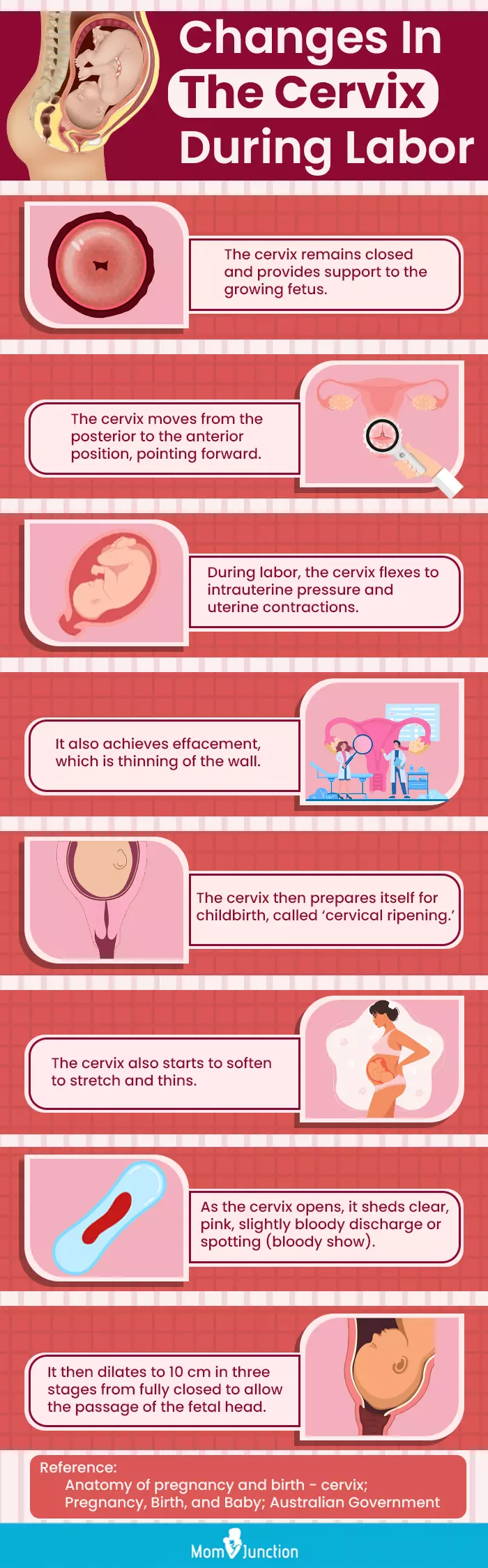 changes in the cervix during labor (infographic)