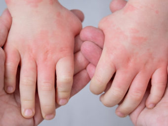 Common Childhood Rashes To Look Out For