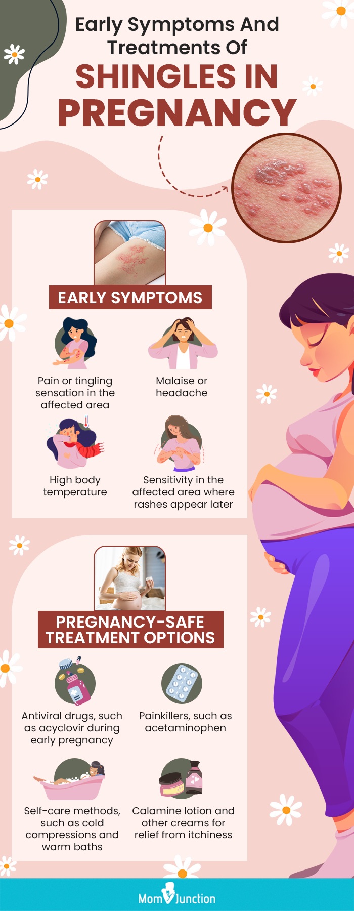 early symptoms and treatments of shingles in pregnancy (infographic)