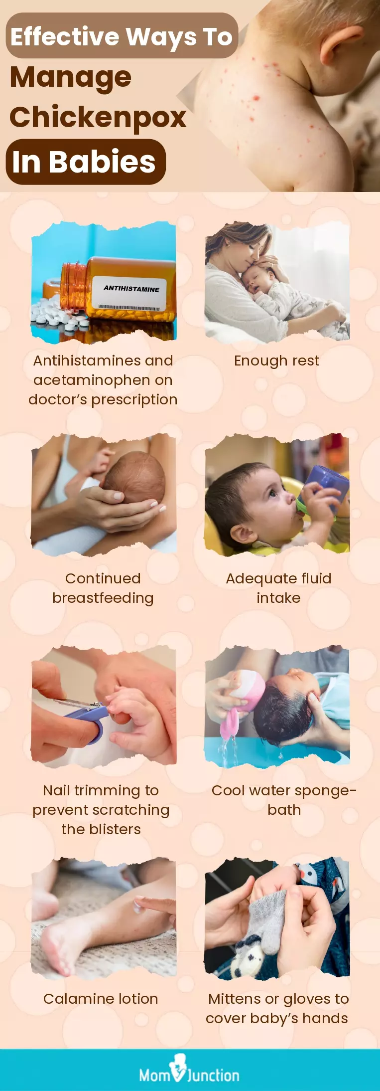 effective ways to manage chickenpox in babies (infographic)