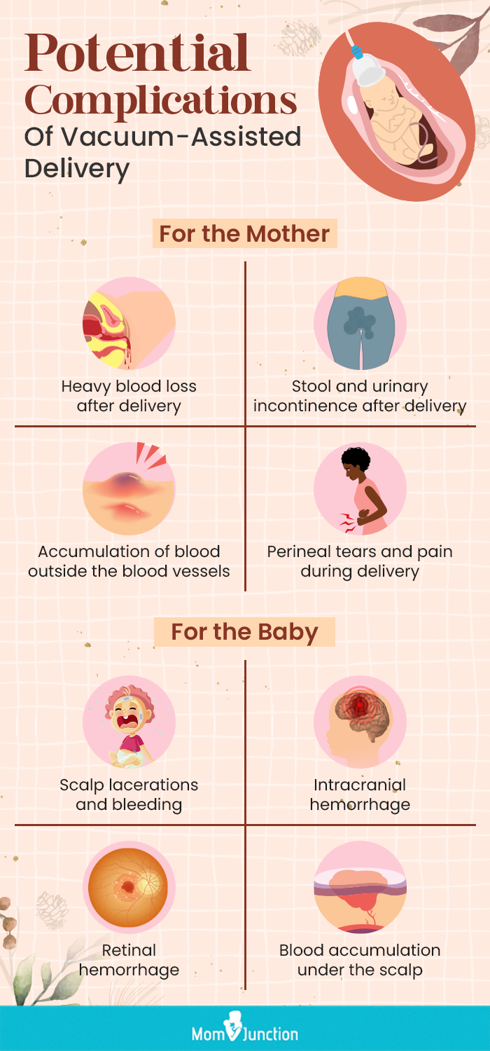 potential complications of vacuum assisted delivery (infographic)