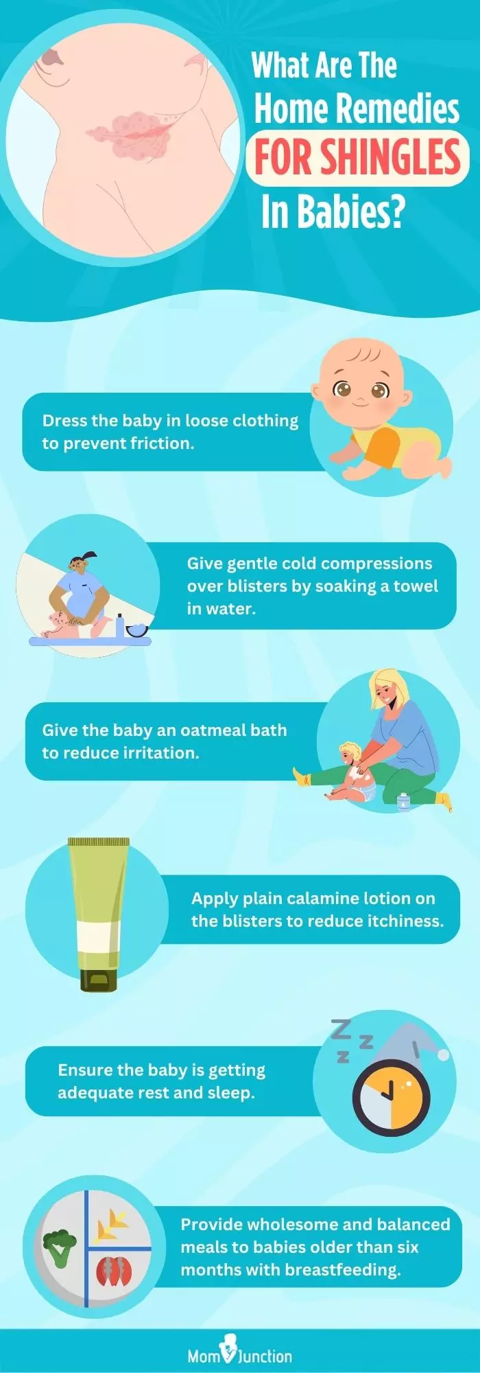 what are the home remedies for shingles in babies (infographic)