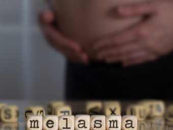 All You Need To Know About Melasma