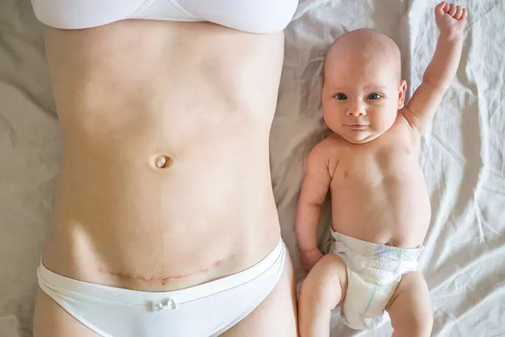 How Can You Prepare For A C-Section