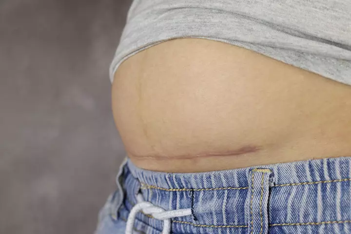 What Are The Possible Side Effects Of A C-Section