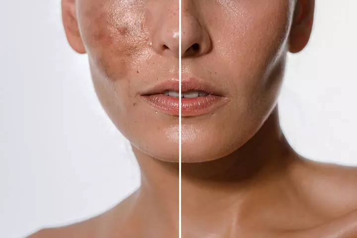 What Causes Melasma