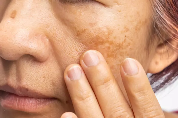 What Is Melasma