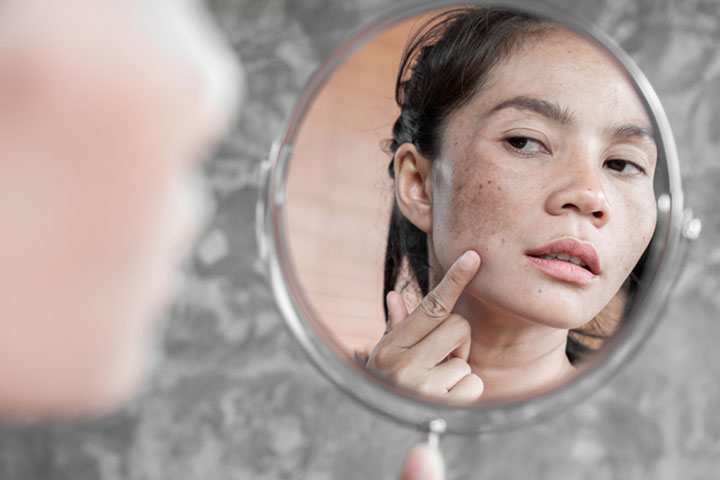Will Melasma Stay Even After Pregnancy