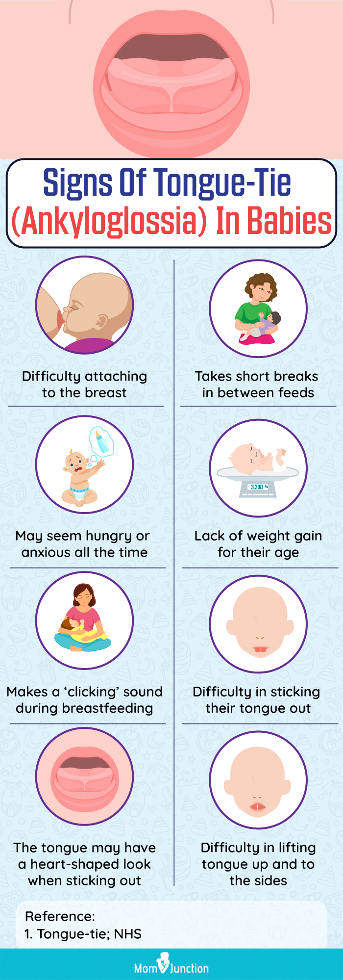 Signs Of Tongue Tie (Ankyloglossia) In Babies (infographic)