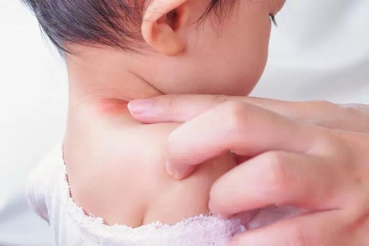 When It’s A Yeast Infection On Your Baby's Neck